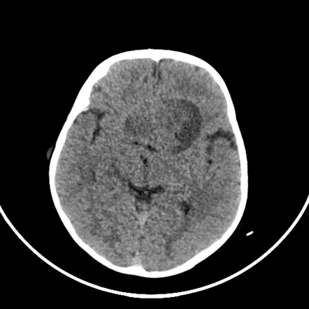 Optic pathway glioma | Radiology Case | Radiopaedia.org