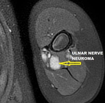 Stump neuromas - upper limb | Image | Radiopaedia.org