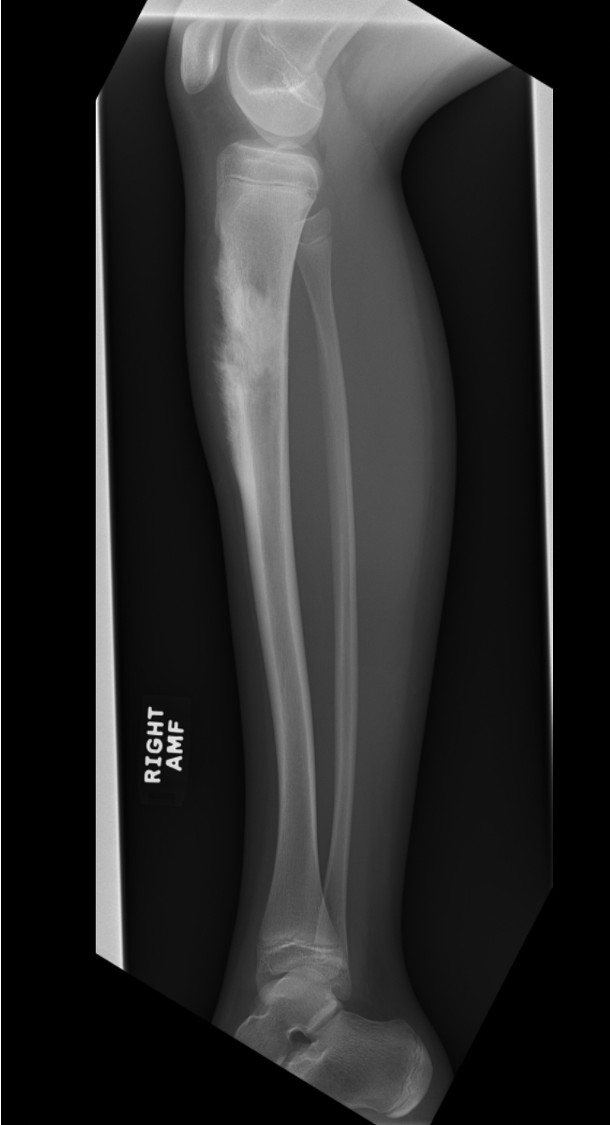 Chondroblastic Osteosarcoma 