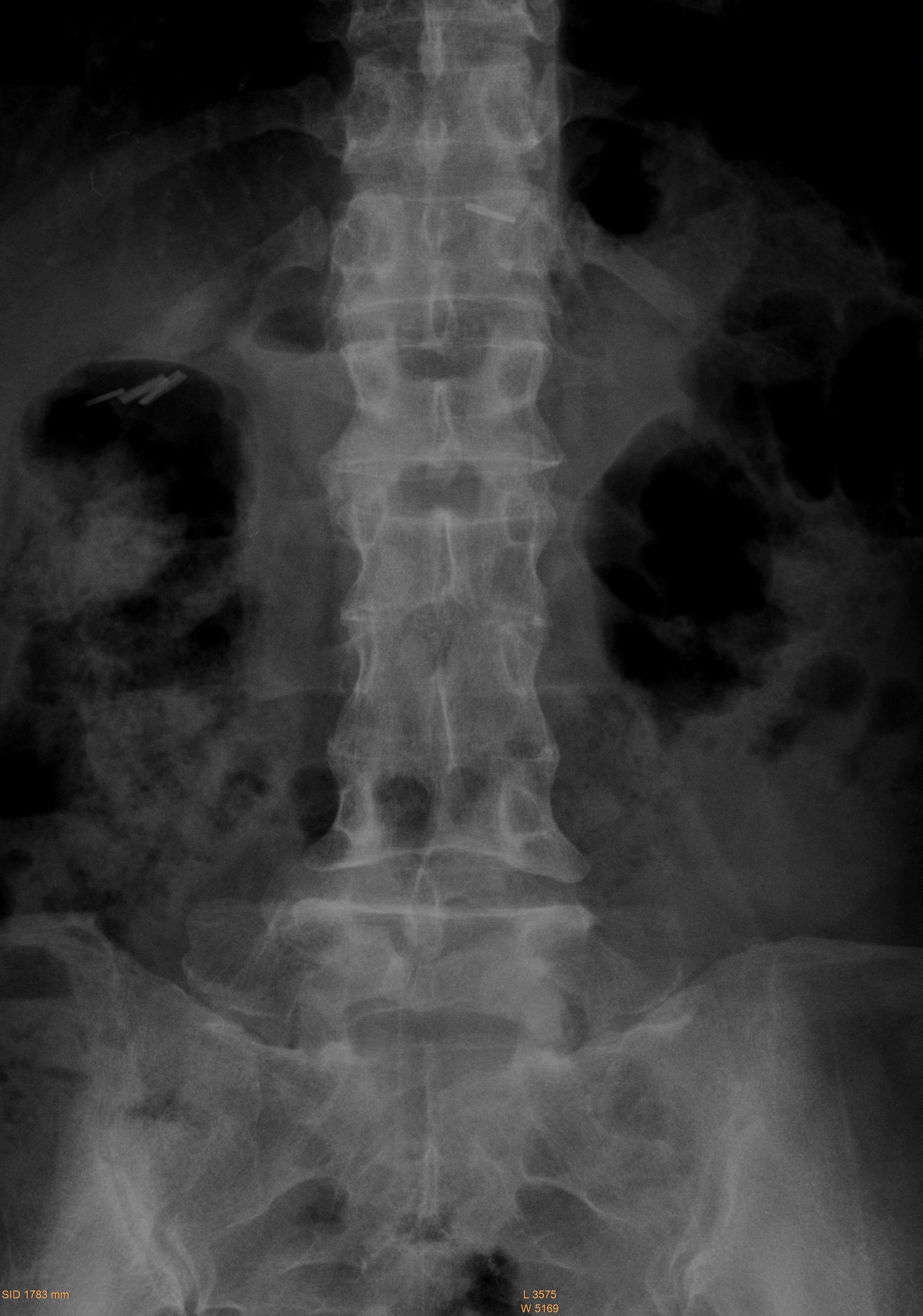 Block vertebra | Image | Radiopaedia.org