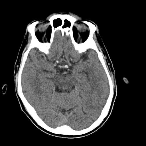 Tuberculoma | Image | Radiopaedia.org