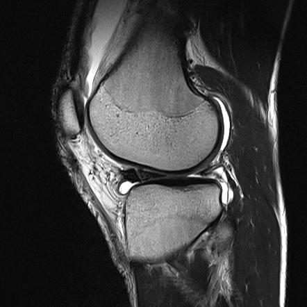 Bucket Handle Tear - Lateral Meniscus 