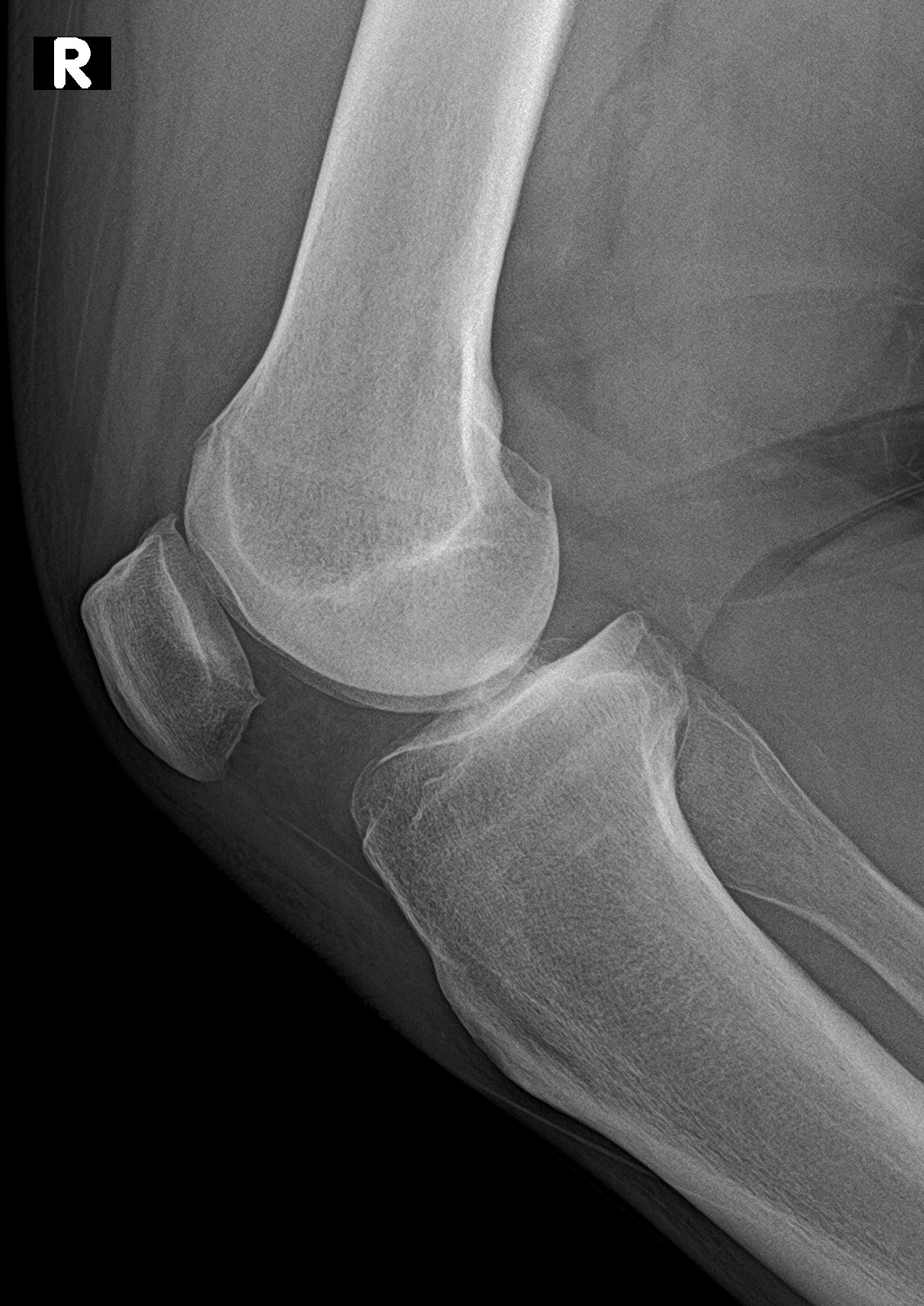 Genu varum - knee osteoarthritis | Image | Radiopaedia.org