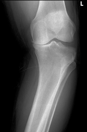 Genu varum - knee osteoarthritis | Image | Radiopaedia.org