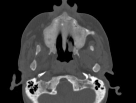 Renal osteodystrophy with brown tumor | Radiology Case | Radiopaedia.org