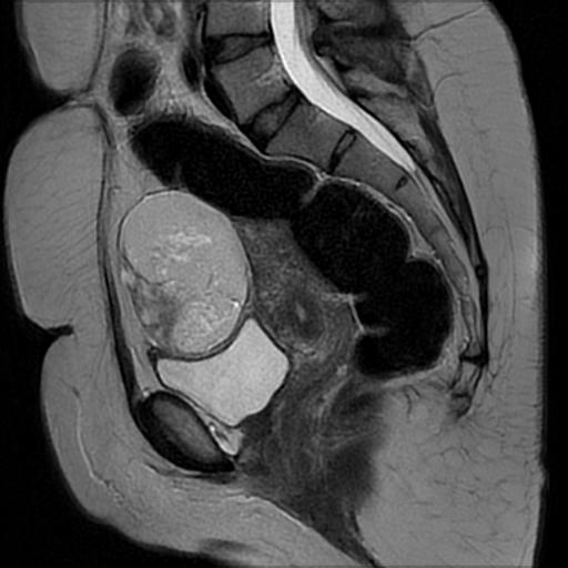 Ovarian Dermoid Cyst Image