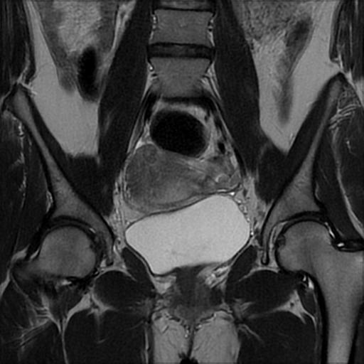 Ovarian dermoid cyst | Image | Radiopaedia.org