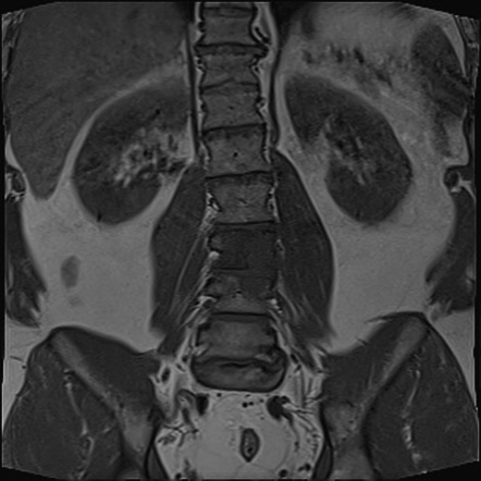 Vertebral metastases - male breast cancer | Radiology Case ...