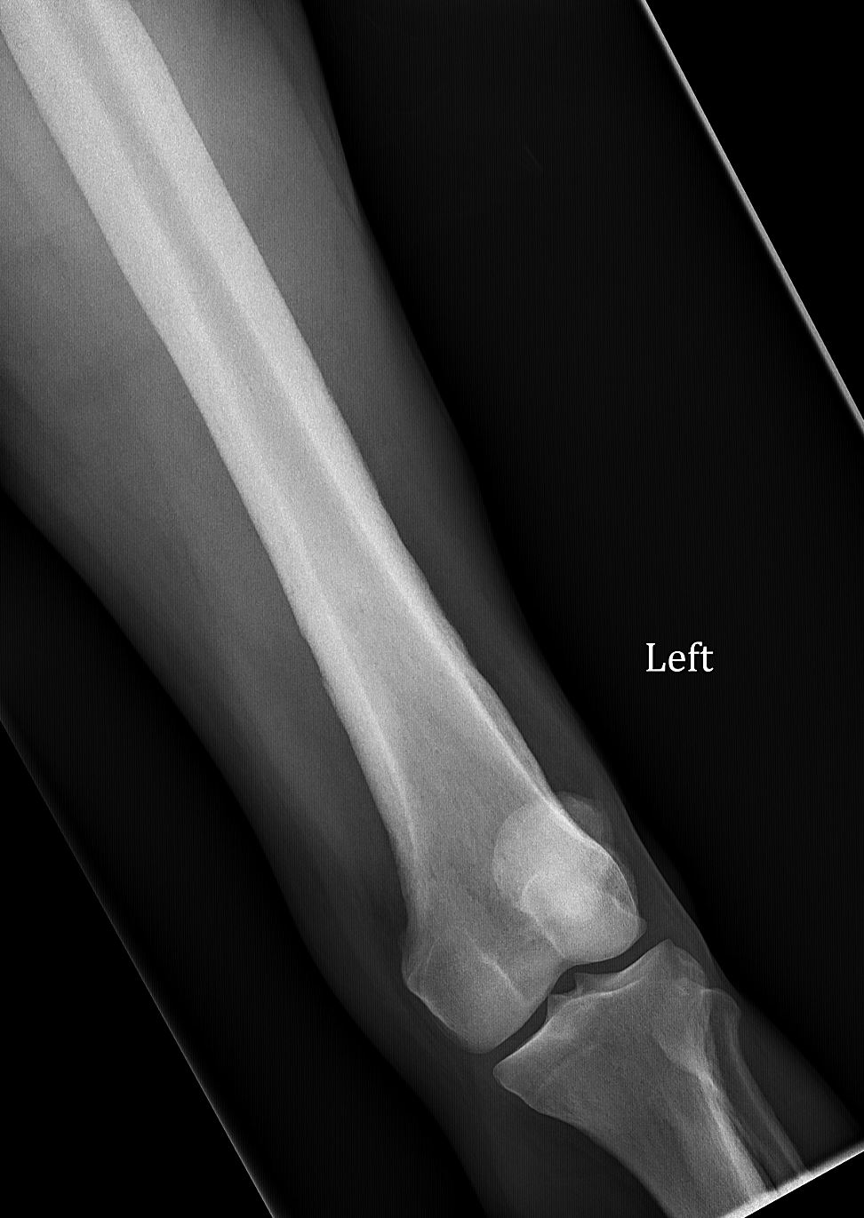 Hypertrophic osteoarthropathy | Image | Radiopaedia.org