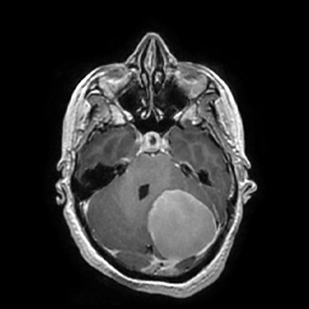 Meningioma | Radiology Case | Radiopaedia.org