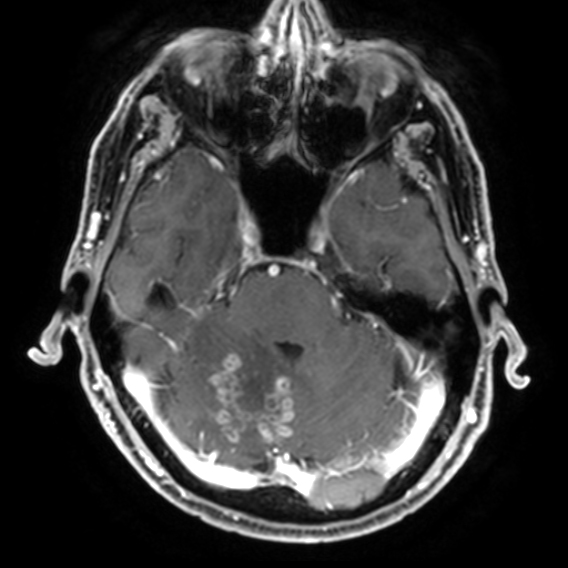 Tuberculoma | Image | Radiopaedia.org