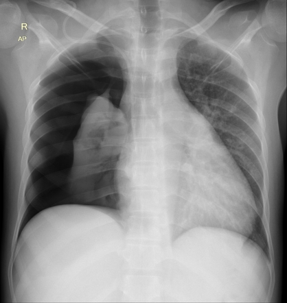 Traumatic pneumothorax | Radiology Case | Radiopaedia.org