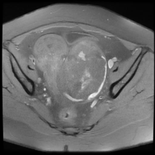 Ovarian Dermoid Cyst Uterine Adenomyosis With Leiomyomas Image