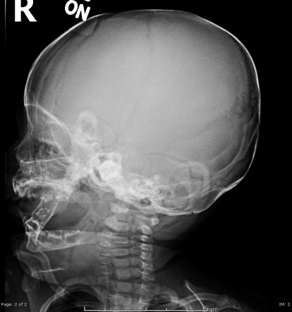 Lambdoid Wormian bones | Image | Radiopaedia.org