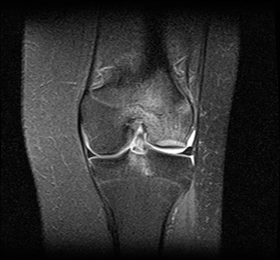 ACL avulsion fracture | Image | Radiopaedia.org