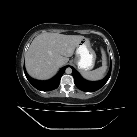 Flash Filling Hepatic Hemangioma Image Radiopaedia Org   IMG 0006 00014 Gallery 