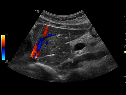 Flash Filling Hepatic Hemangioma Image Radiopaedia Org   Hemangioma03 Gallery 