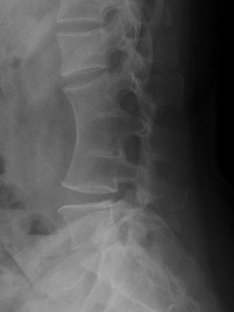 Block vertebra | Radiology Reference Article | Radiopaedia.org