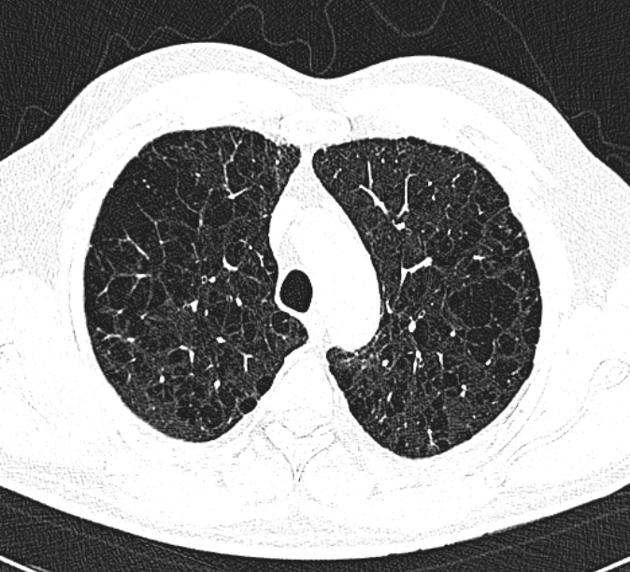 Pulmonary Emphysema Radiology Reference Article