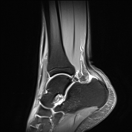 Intratendinous ganglion cyst of the Achilles tendon | Image ...