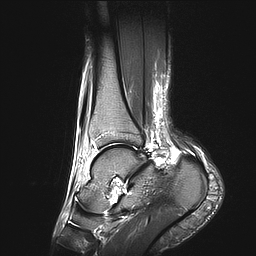 Intratendinous ganglion cyst of the Achilles tendon | Image ...