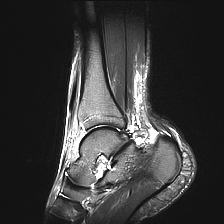 Intratendinous ganglion cyst of the Achilles tendon | Image ...