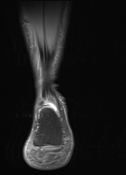 Intratendinous ganglion cyst of the Achilles tendon | Image ...