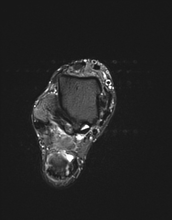 Intratendinous ganglion cyst of the Achilles tendon | Radiology Case ...