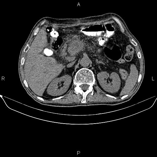 Pancreatic Cancer | Image | Radiopaedia.org