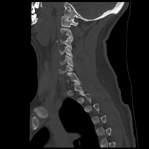 Cervical Spine Floating Lateral Mass Fracture Image 3772