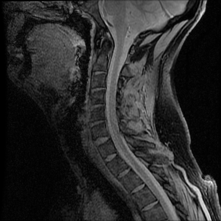 Cervical spine floating lateral mass fracture | Image | Radiopaedia.org