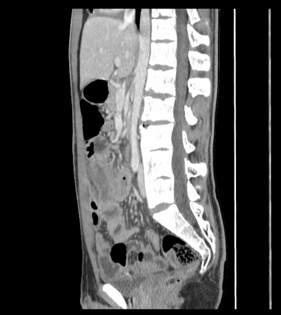 Wandering spleen with volvulus and infarction | Image | Radiopaedia.org