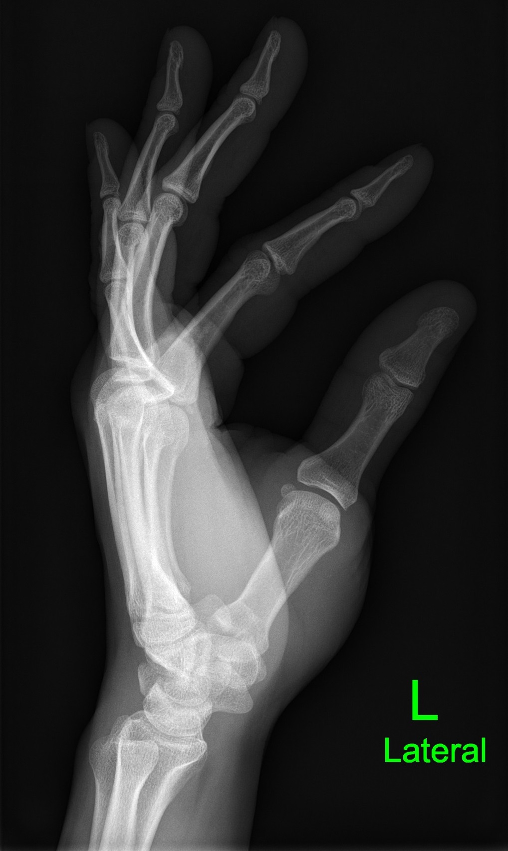 Bennet fracture | Image | Radiopaedia.org