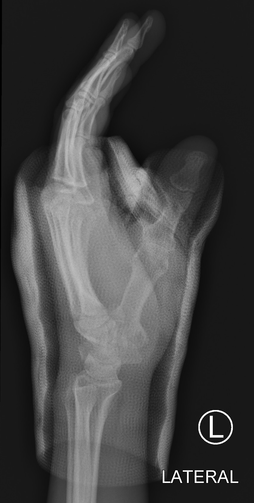 Bennet fracture | Image | Radiopaedia.org