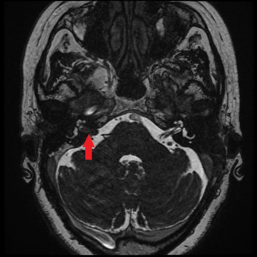 Intracanalicular Vestibular Schwannoma Radiology Case