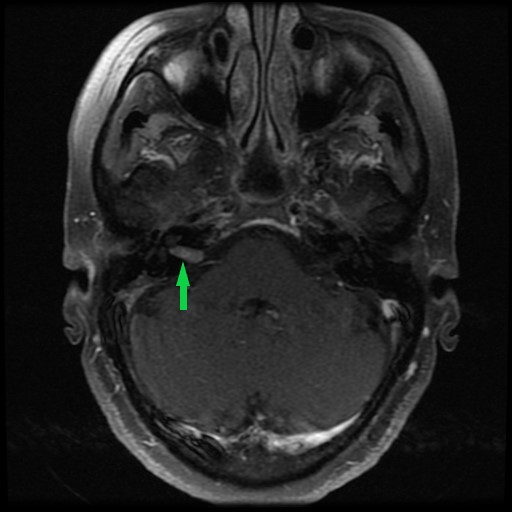 Intracanalicular Vestibular Schwannoma Radiology Case