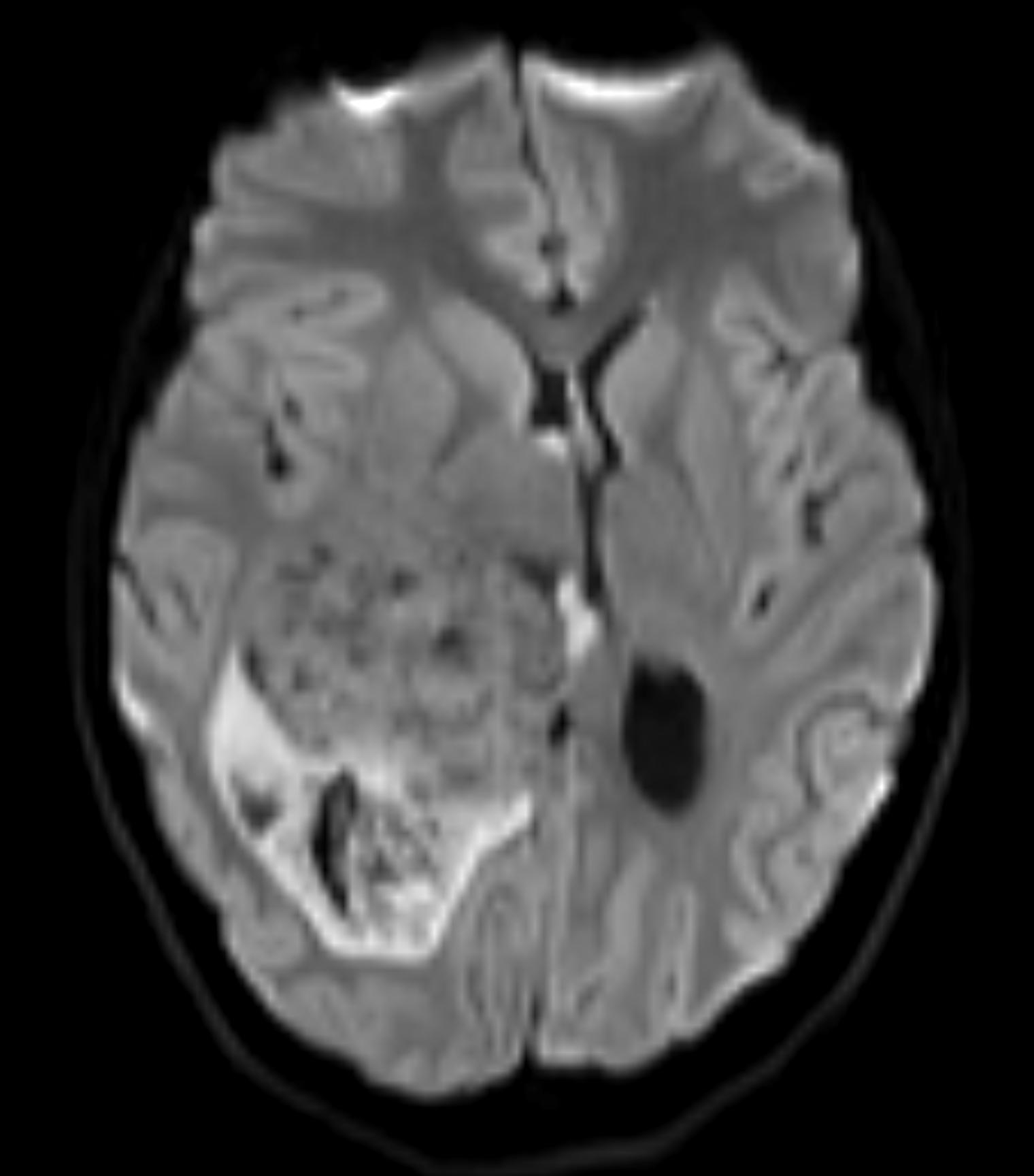 Choroid Plexus Carcinoma | Image | Radiopaedia.org