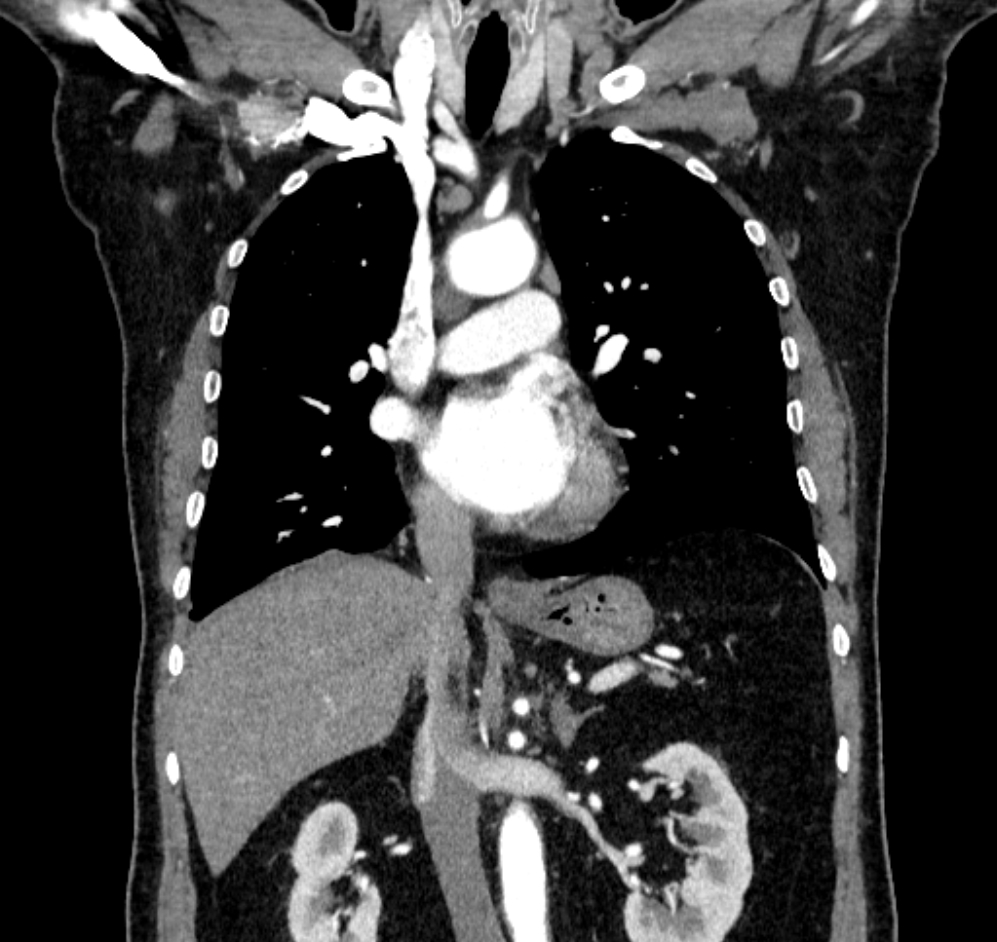 Round atelectasis | Image | Radiopaedia.org