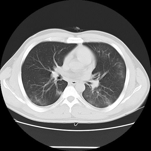 COVID-19 pneumonia | Image | Radiopaedia.org