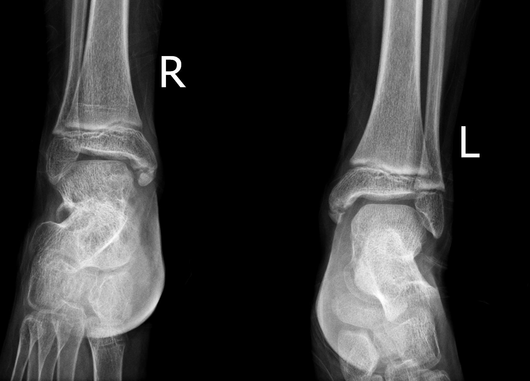 Medial malleolus ossification center (9-year-old) | Image | Radiopaedia.org