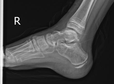 Medial Malleolus Ossification Center