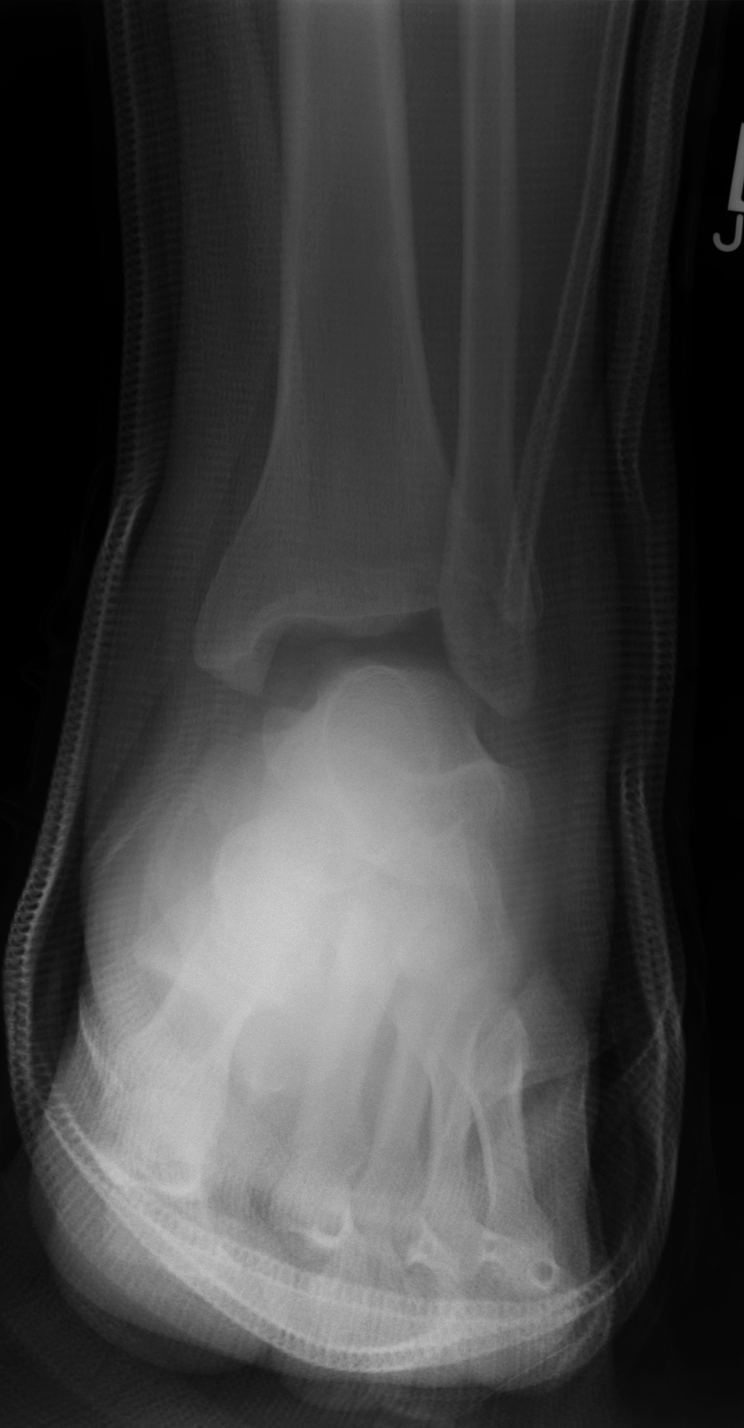 Complete talar dislocation | Image | Radiopaedia.org