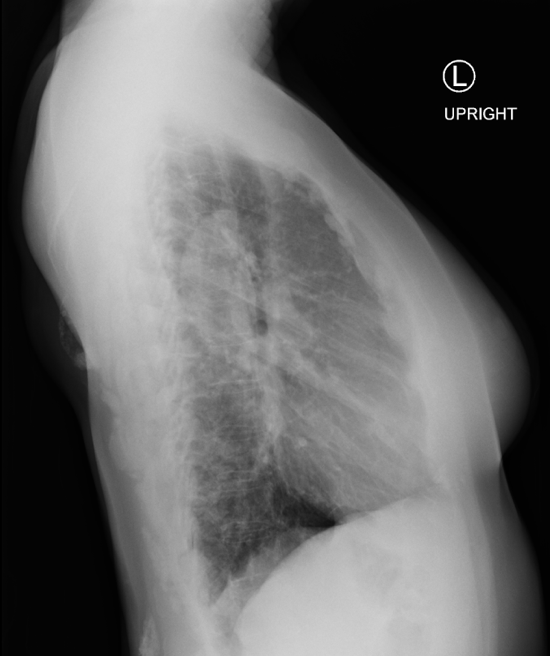 Dermatomyositis Image