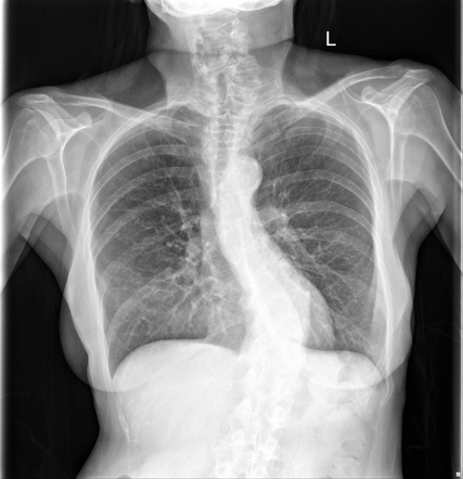 Right middle lobe collapse and consolidation due to mucus plug ...