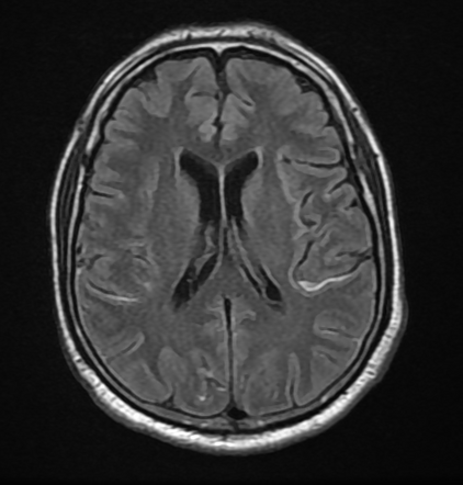 Subarachnoid FLAIR hyperintensity | Radiology Reference Article ...