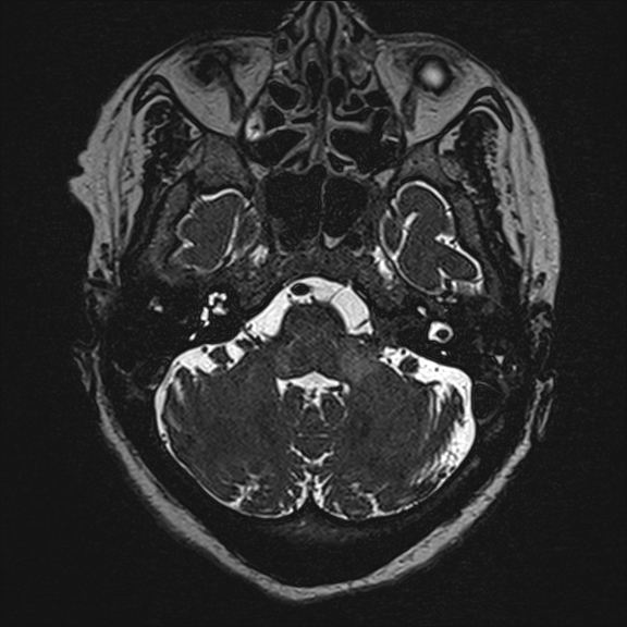 Multiple cranial nerve thickening and enhancement | Image | Radiopaedia.org