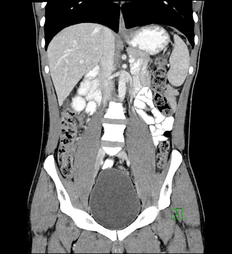 Subhepatic appendicitis | Image | Radiopaedia.org