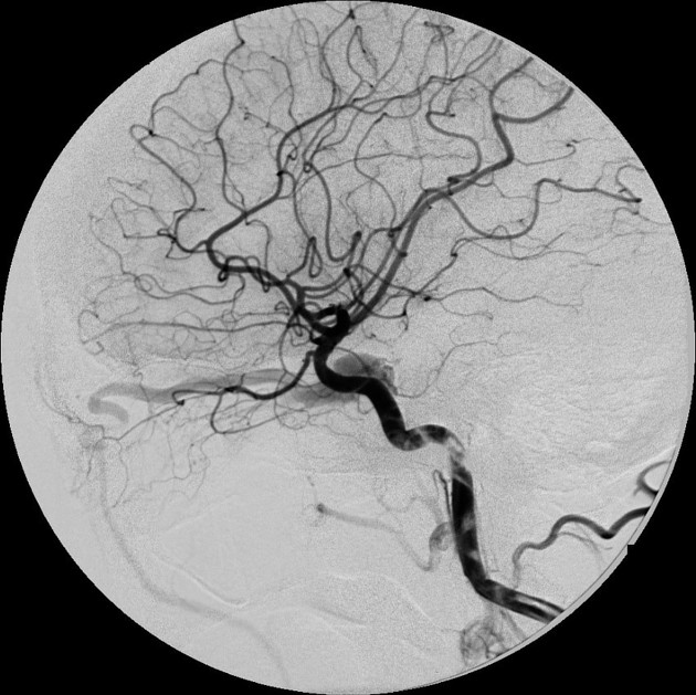 Caroticocavernous fistula Radiology Reference Article