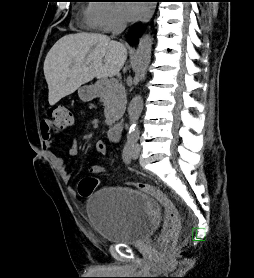 Sickle Cell Disease Abdominal Manifestations Image