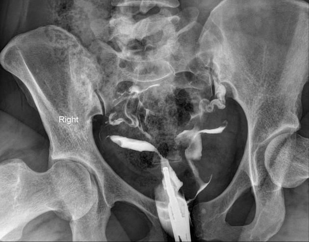 Uterine Didelphys Radiology Case Radiopaediaorg